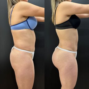 Vorher-nachher-Ergebnis Brazilian Butt Lift bei Dr. Alexandro Aguilera - Plastic Surgery