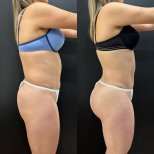 Vorher-nachher-Ergebnis Brazilian Butt Lift bei Dr. Alexandro Aguilera - Plastic Surgery