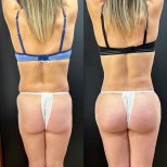 Vorher-nachher-Ergebnis Brazilian Butt Lift bei Dr. Alexandro Aguilera - Plastic Surgery