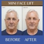 Фото до та після мініпідтяжки обличчя, доктор 