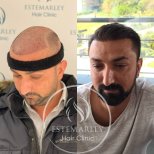 نتائج زراعة الشعر قبل وبعد في عيادة Estemarley – استعادة خط الشعر وكثافة أكبر