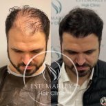 نتائج زراعة الشعر قبل وبعد في عيادة Estemarley – خط شعر مستعاد وكثافة أكبر