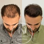 نتائج زراعة الشعر قبل وبعد في Estemarley – استعادة خط الشعر وكثافة أكبر