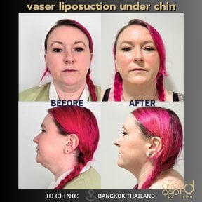 До и после Vaser липосакции подбородка в ID Clinic Bangkok, видимый контур