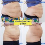 Before and after tummy tuck and liposuction results at Asia Cosmetic Hospital, flatter abdomen