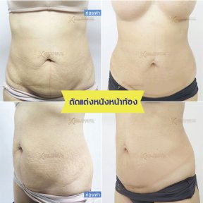 Before and after tummy tuck results at Asia Cosmetic Hospital – flatter, firmer abdomen