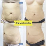 Before and after tummy tuck results at Asia Cosmetic Hospital – flatter, firmer abdomen
