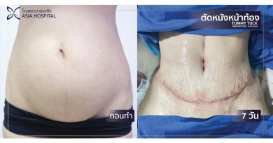Before and after tummy tuck results at Asia Cosmetic Hospital, visible flatter abdomen outcome