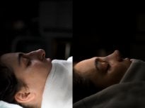 Before and after rhinoplasty results at Op. Dr. Sinan Eroglu Clinic, improved nose profile