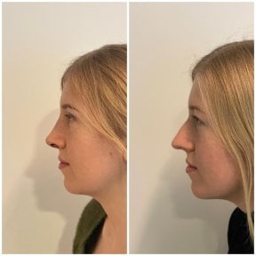 Résultats avant/après implant de menton à la clinique Op. Dr. Sinan Eroglu, profil amélioré