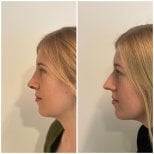 Résultats avant/après implant de menton à la clinique Op. Dr. Sinan Eroglu, profil amélioré
