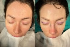 Avant et après préparation blépharoplastie à la clinique Op. Dr. Sinan Eroglu, résultat