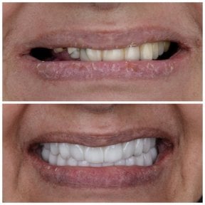 Résultat avant et après implants All-on-6 chez Omara Dental Centers, sourire amélioré
