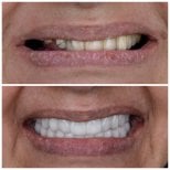 Résultat avant et après implants All-on-6 chez Omara Dental Centers, sourire amélioré