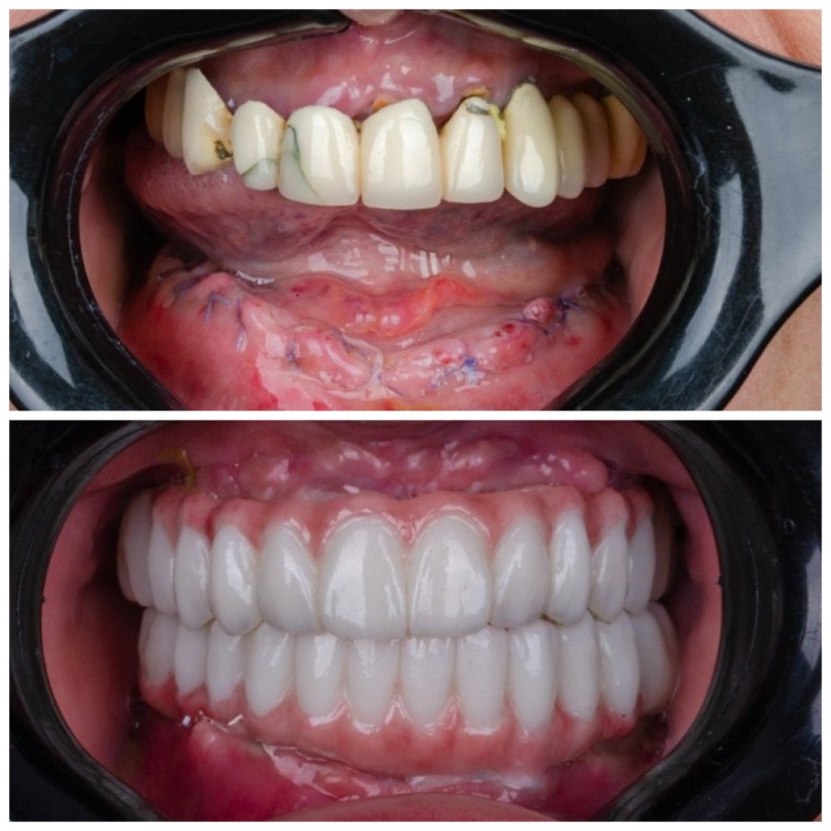 نتيجة قبل وبعد زراعة الأسنان All-on-6 في Omara Dental Centers، استعادة الابتسامة الكاملة