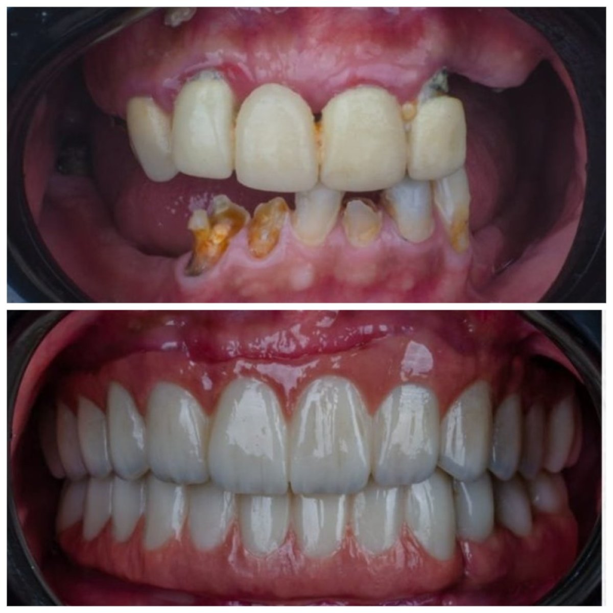 نتيجة قبل وبعد زراعة الأسنان All-on-4 في Omara Dental Centers، استعادة الابتسامة الكاملة