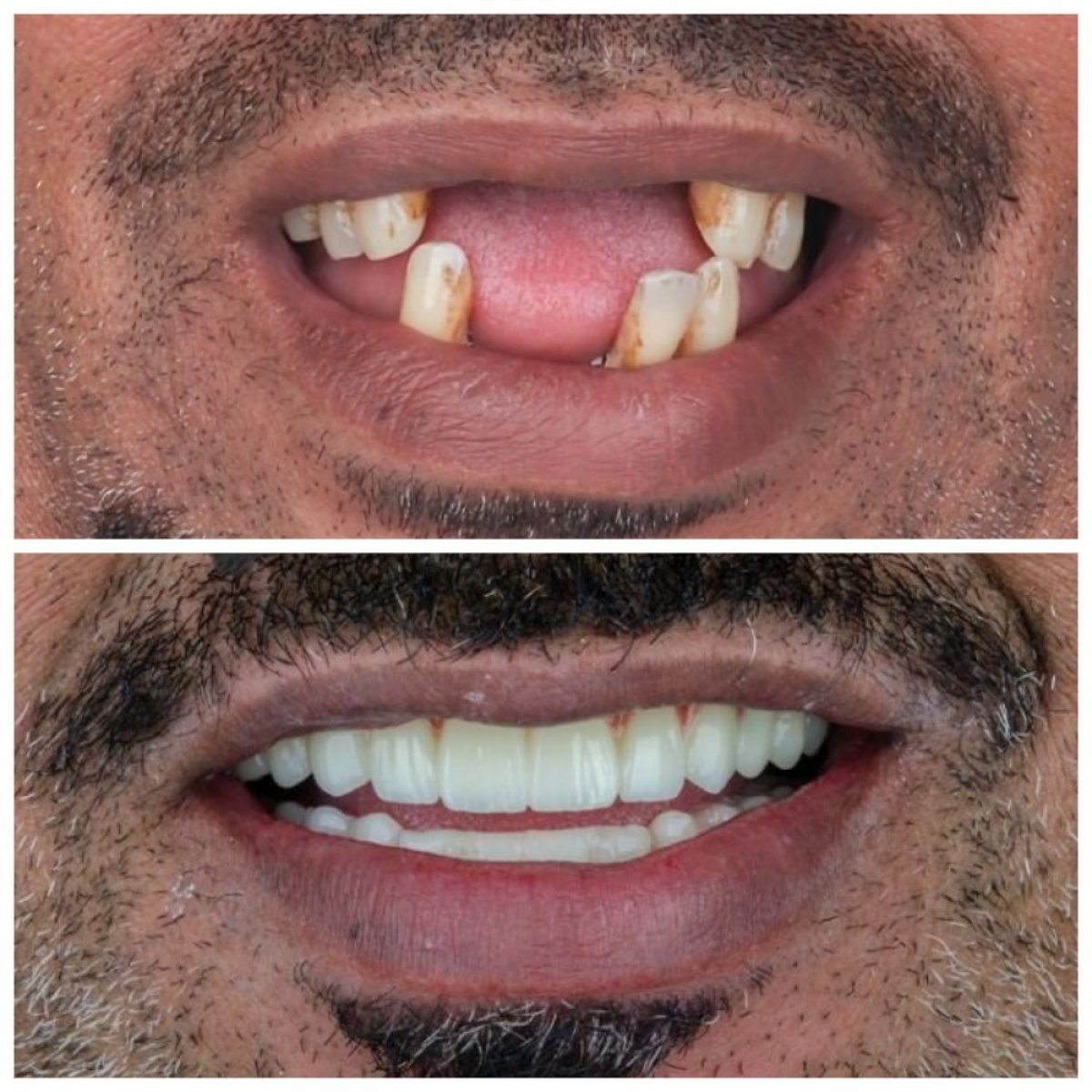 Resultado antes y después de implantes dentales All-on-4 en Omara Dental Centers, sonrisa restaurada