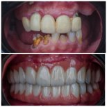 Before and after All-on-6 dental implants result at Omara Dental Centers, full smile restoration