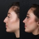 Resultados de rinoplastia antes y después, remodelación nasal para mejor perfil y estética