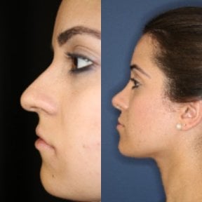 Resultados de rinoplastia antes y después, remodelación nasal para mejor perfil facial