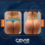 Vorher-nachher-Ergebnis Po-Lifting bei Adem and Havva Medical Center, verbesserte Kontur