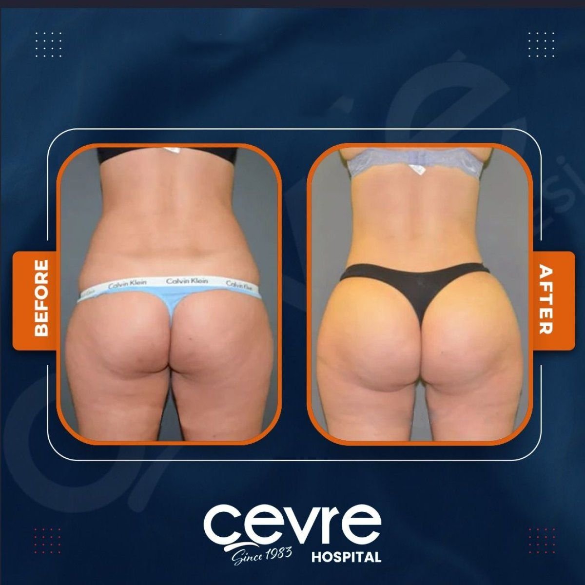 Resultados de lifting de glúteos antes y después en Adem and Havva Medical Center, mejor contorno