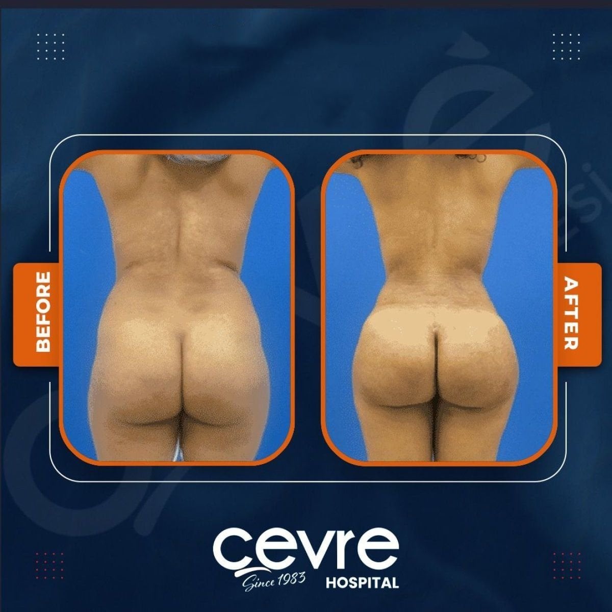 نتائج شد المؤخرة قبل وبعد في Adem and Havva Medical Center، تحسين الشكل