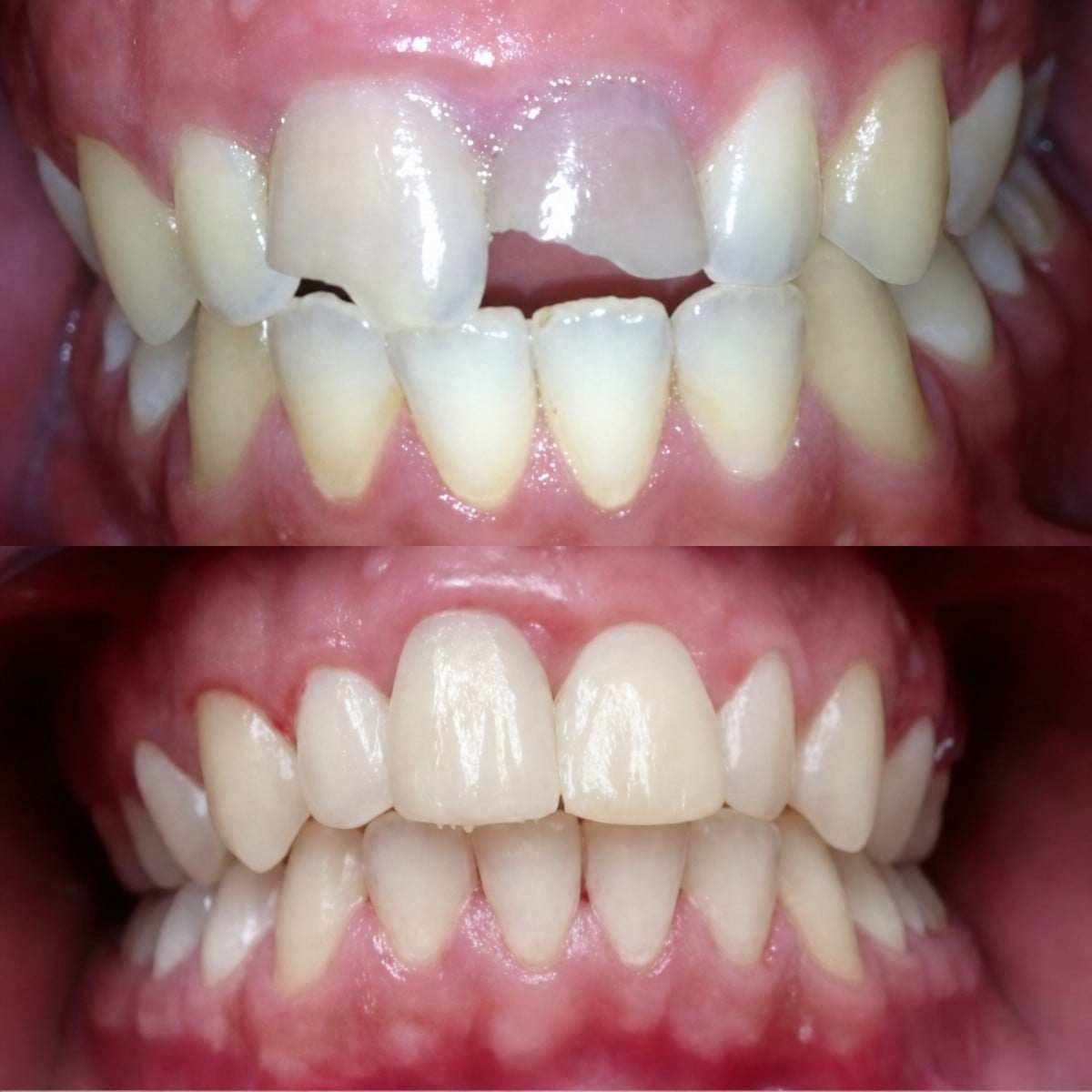 نتائج قبل وبعد قشور الكمبوزيت في عيادة د. زويلا فرنانديز، تجميل الابتسامة