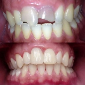 Before and after composite veneer results at Dra Zoila Fernández's Private Practice, smile makeover