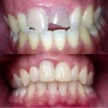 Before and after composite veneer results at Dra Zoila Fernández's Private Practice, smile makeover