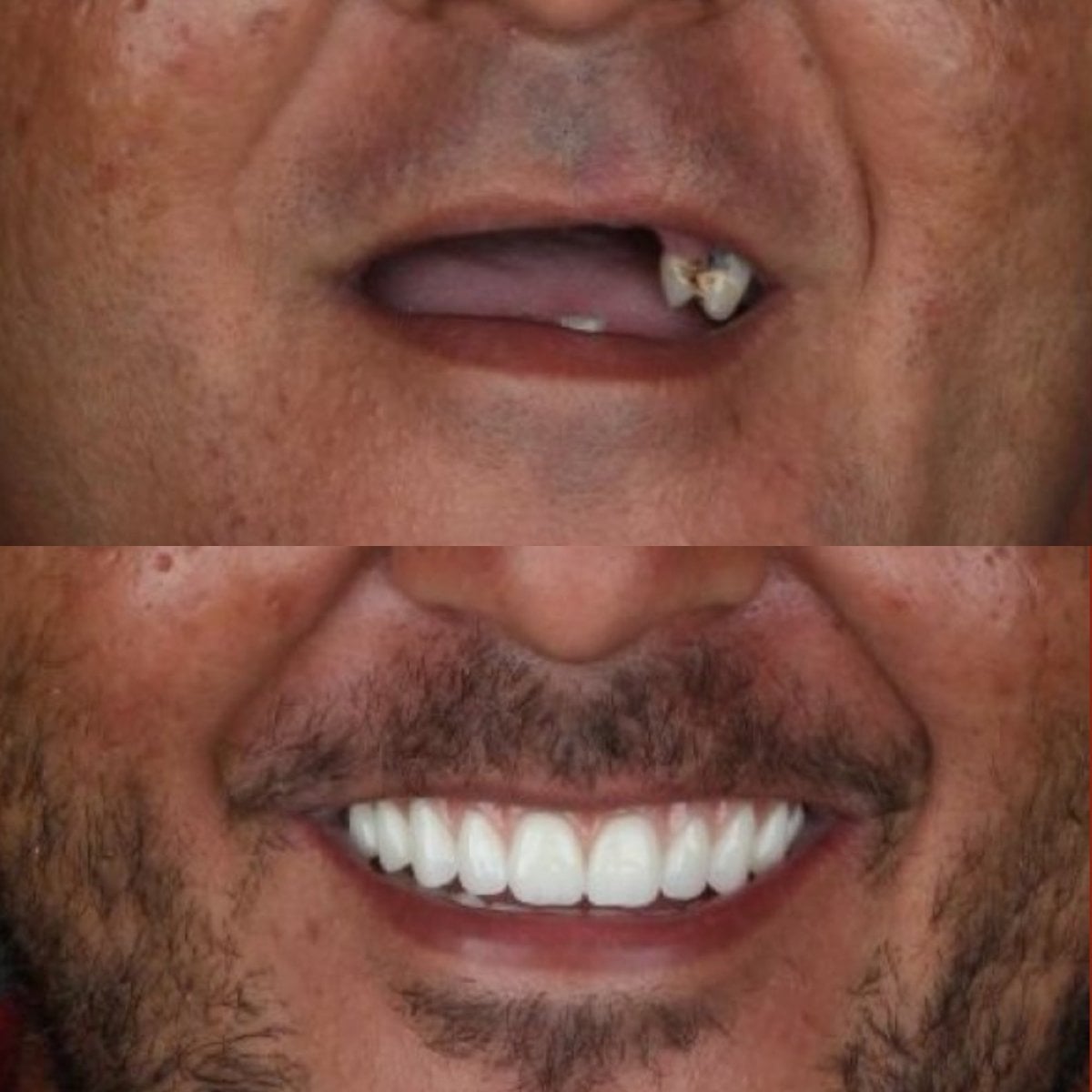 Resultado antes y después de implantes dentales All-on-6 en European Valley Health, sonrisa restaurada