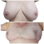 Before and after breast implant revision results at Hospital de la Familia, improved contour