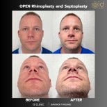 Фото до и после ринопластики (пластики носа), доктор