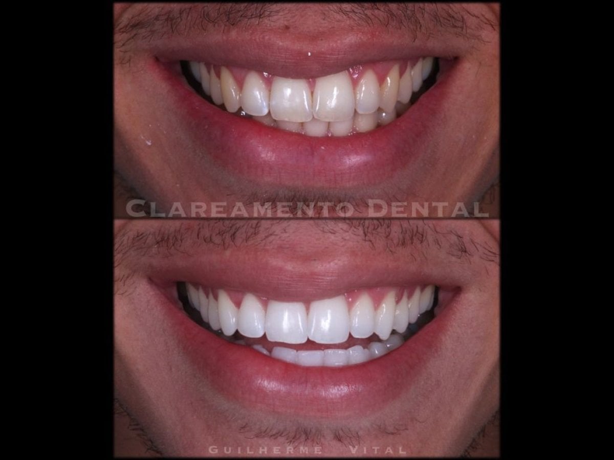 Resultados de blanqueamiento dental antes y después en European Valley Health – sonrisa más blanca