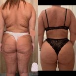 Before and after liposuction results at Dr. MED – visible body contouring and fat reduction