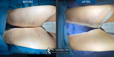 Before and after thigh lift results at Dr. Safa Manav Clinic, improved thigh contour visible
