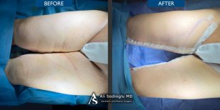Before and after thigh lift results at Dr. Safa Manav Clinic, improved thigh contour visible