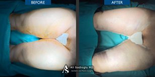 Before and after thigh lift results at Dr. Safa Manav Clinic, improved thigh contour visible