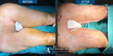 Before and after thigh lift results at Dr. Safa Manav Clinic, improved thigh contour visible
