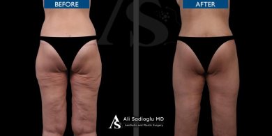 Before and after thigh lift results at Dr. Safa Manav Clinic, smoother and firmer thighs