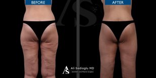 Before and after thigh lift results at Dr. Safa Manav Clinic, smoother and firmer thighs