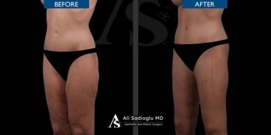 Before and after thigh lift results at Dr. Safa Manav Clinic, improved thigh contour visible