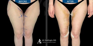 Before and after thigh lift results at Dr. Safa Manav Clinic, improved thigh contour visible