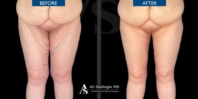 Before and after thigh lift results at Dr. Safa Manav Clinic, improved thigh contour visible