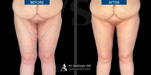 Before and after thigh lift results at Dr. Safa Manav Clinic, improved thigh contour visible