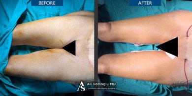 Before and after thigh lift results at Dr. Safa Manav Clinic, improved thigh contour visible