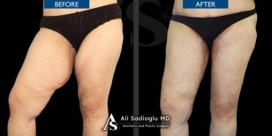 Before and after thigh lift results at Dr. Safa Manav Clinic – smoother, firmer thighs