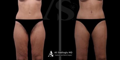 Before and after thigh lift results at Dr. Safa Manav Clinic, improved thigh contour and skin