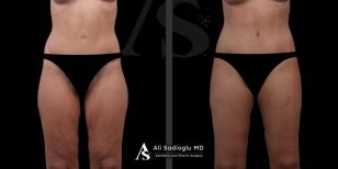 Before and after thigh lift results at Dr. Safa Manav Clinic, improved thigh contour and skin