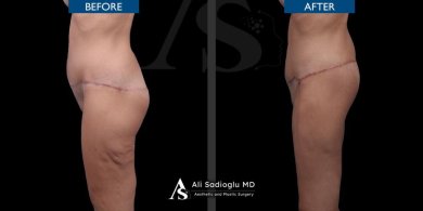Before and after thigh lift results at Dr. Safa Manav Clinic, improved thigh contour visible